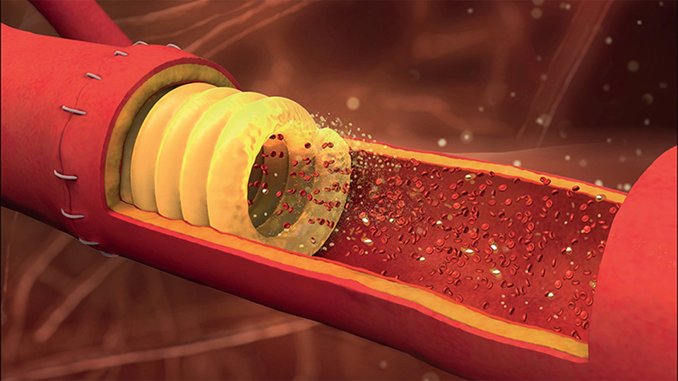A rendering of a millimeter-scale, sugar-based stent designed by Nebraska's Ali Tamayol and his colleagues.