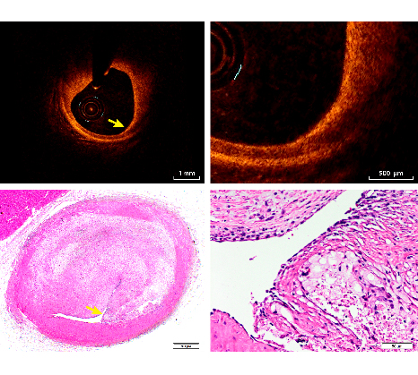 Image: Plaque Burden Influences Accurate Classification of Fibrous Cap Atheroma by In-Vivo Optical Coherence Tomography in a Porcine Model of Advanced Coronary Atherosclerosis